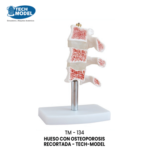 TM-134 Cutaway Osteoporosis